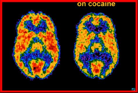 Jogo De Cocaina No Cerebro